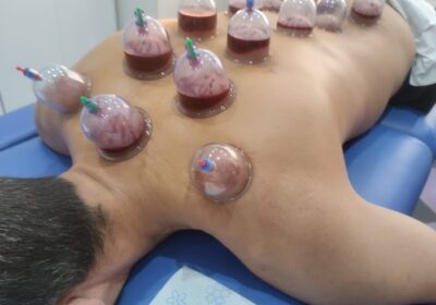 Acupuntura Para El Dolor